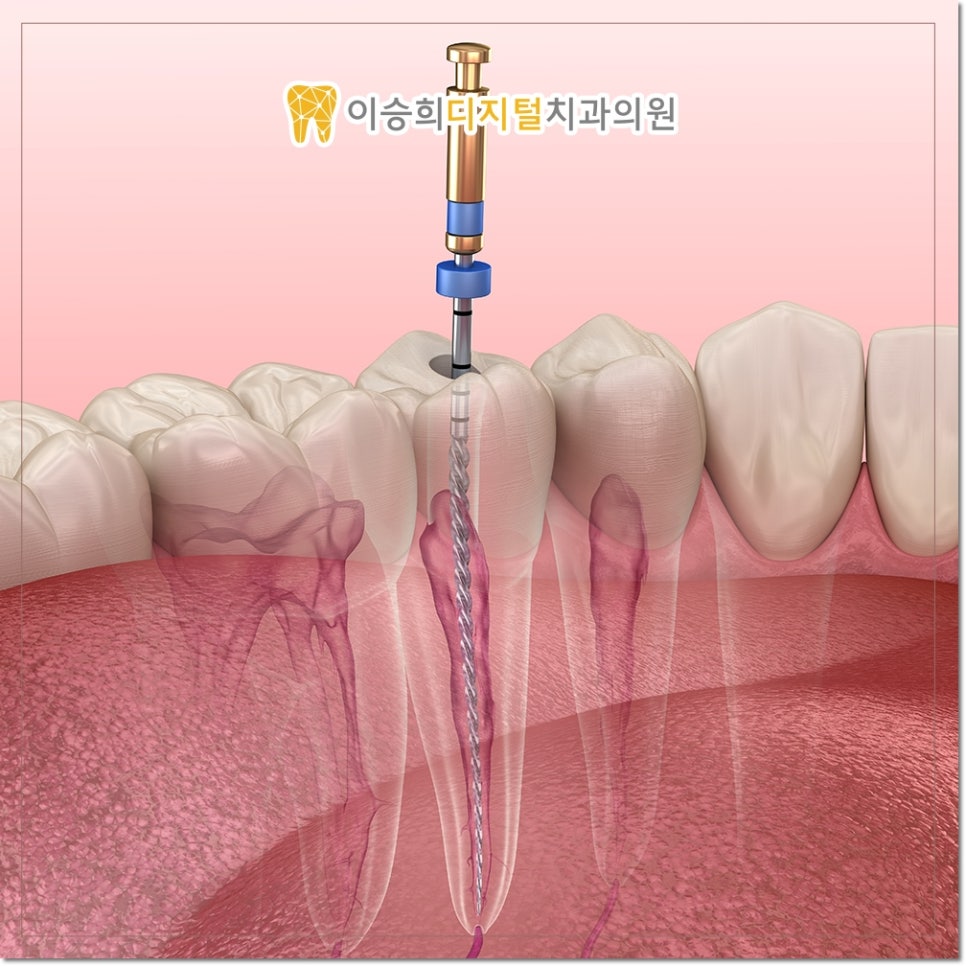온천장플라즈마신경치료